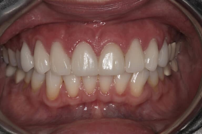 After Image: Veneers - front