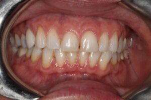 Before Image: Veneers