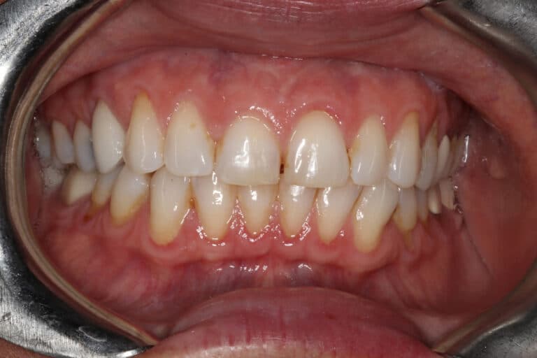 Before Image: Veneers - front