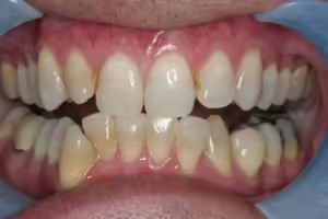 After Image: Teeth Whitening