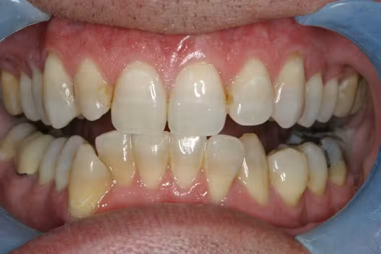 After Image: Teeth Whitening - front