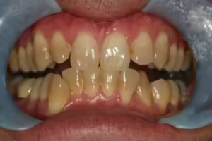 Before Image: Teeth Whitening