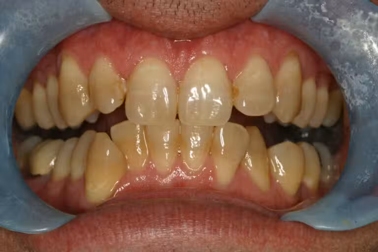 Before Image: Teeth Whitening - front