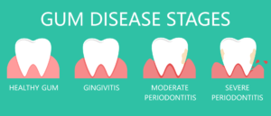 Image of gum disease stages in Las Vegas, NV