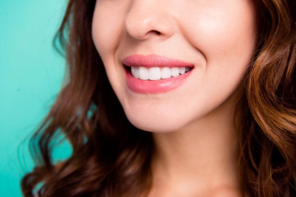 A close-up shot of a woman's smile after getting porcelain dental veneers