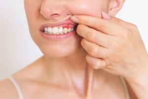 A cropped shot of a woman lifting her lip and showing infected gums