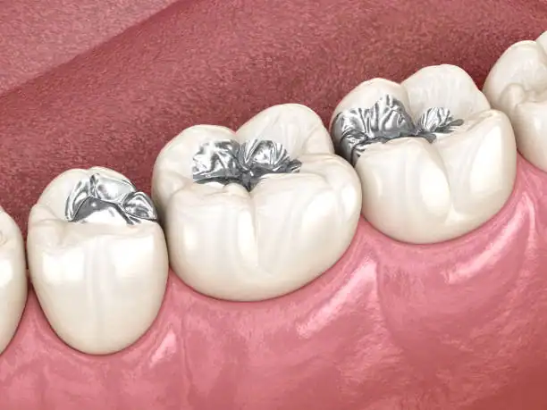 benefits of tooth colored fillings Las Vegas
